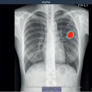 Vuno Med-Chest X-Ray Inteligência Artificial para Raio-X