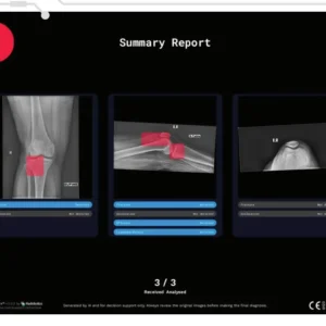 Radiobotics – RBfracture Inteligência Artificial para Raio-X